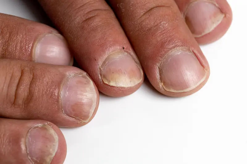 Nail Psoriasis Complete Guide